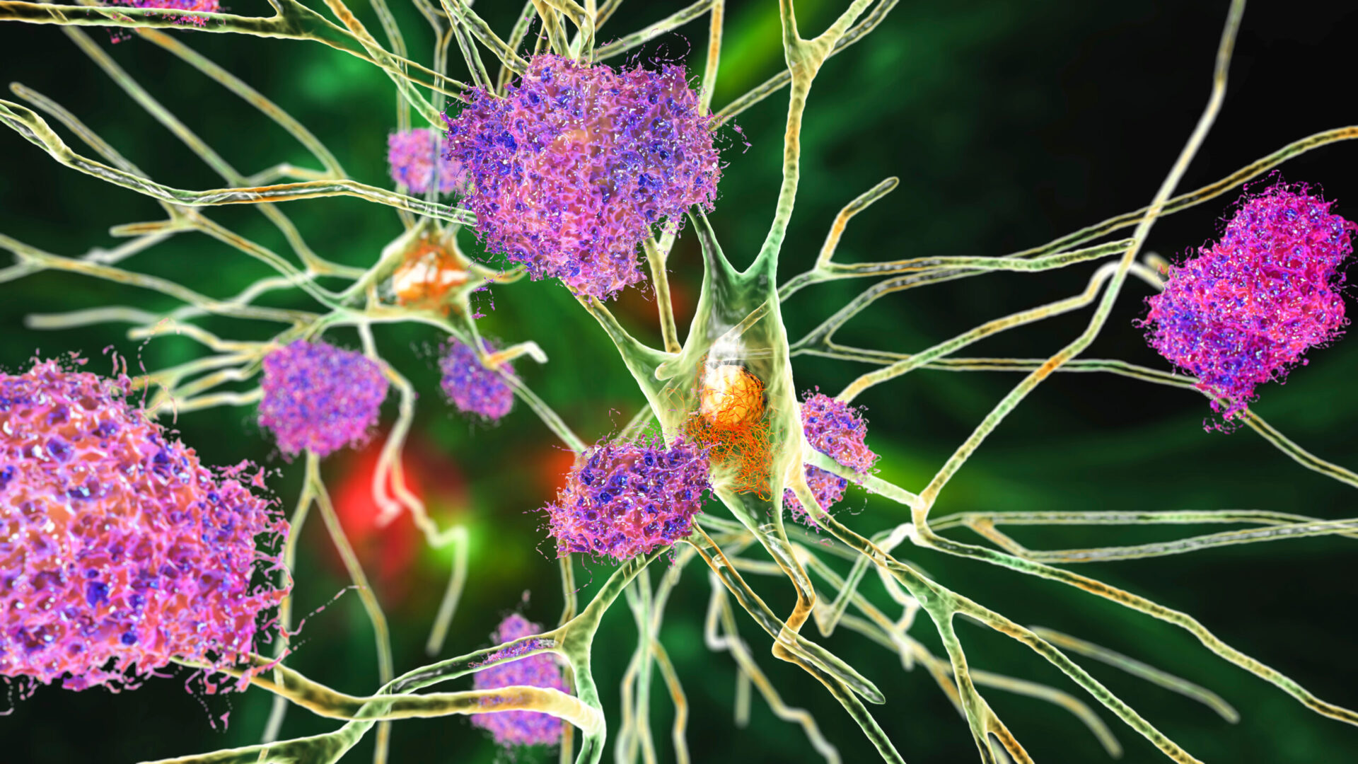 Alzheimer's Disease and Dementia - CE4Less
